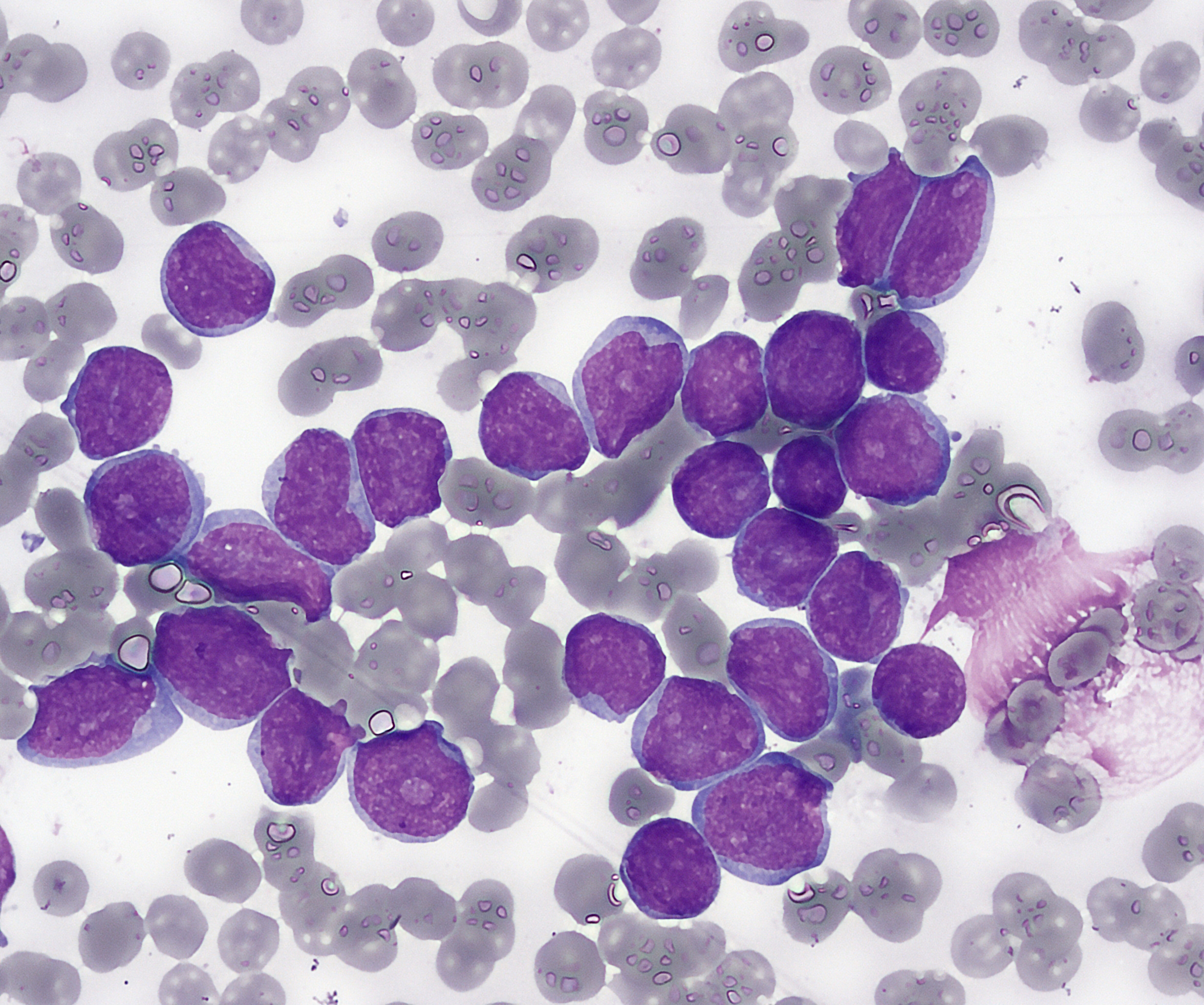 Bone marrow smear under the microscope, showing cancer cell analysis in medical research